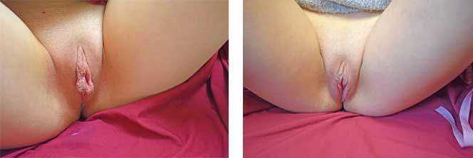 Before & After Labiaplasty #3