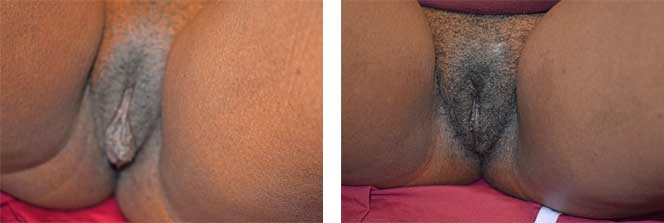 Before & After Labiaplasty #4