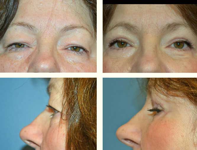 Blepharoplasty (eyelids) #2