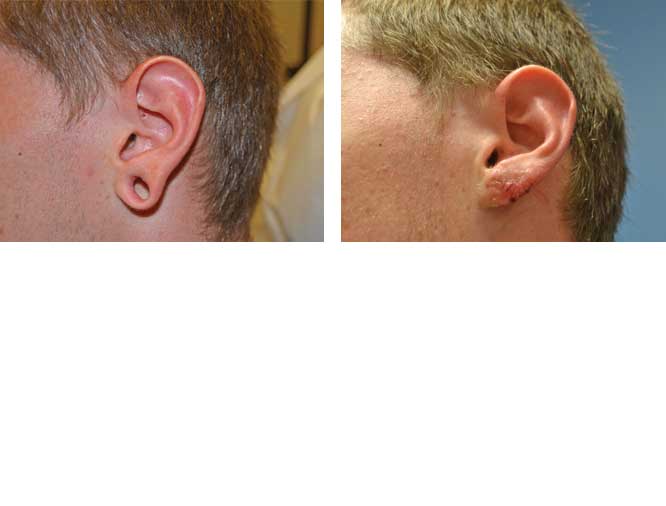 Ear Lobe Repair #3