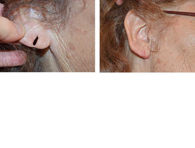 Ear Lobe Repair #2