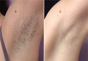 photo of Laser Hair Removal Underarm #1